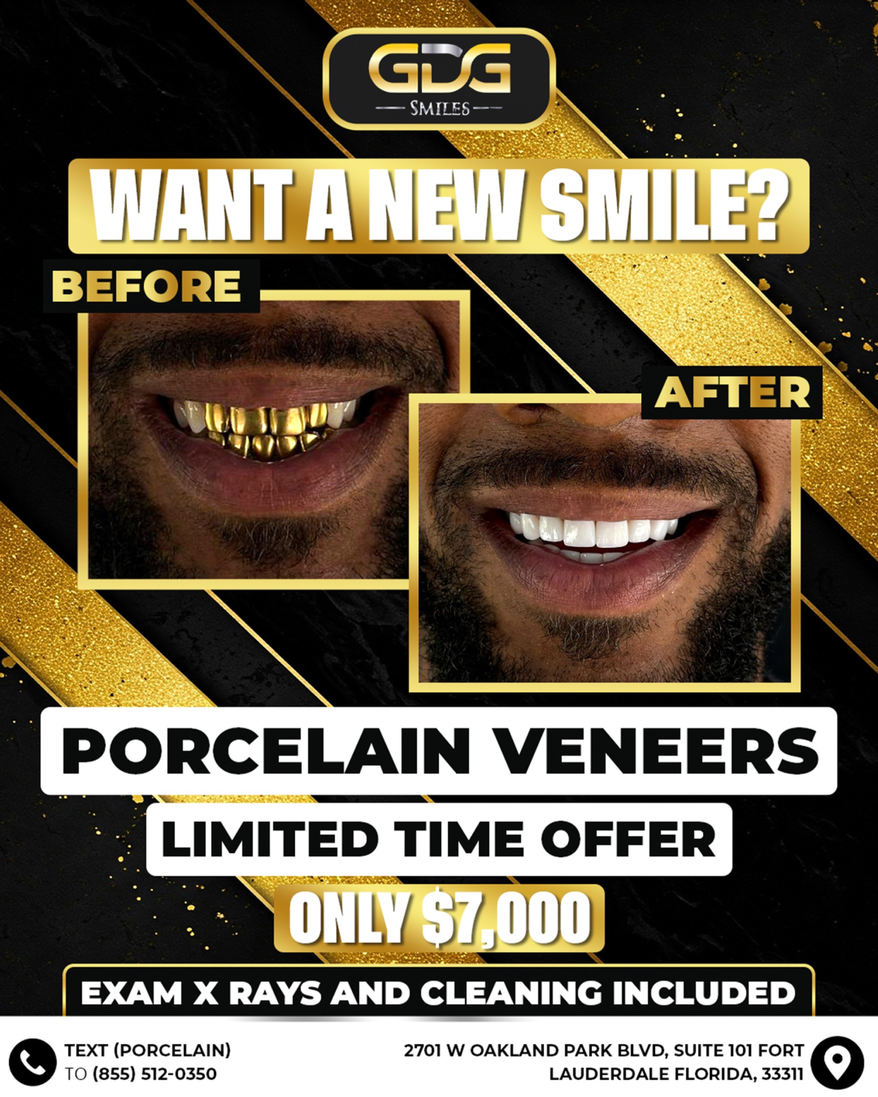 Porcelain Veneers